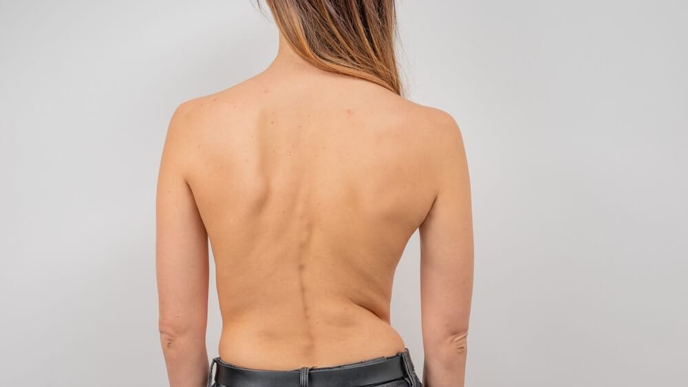 Yoga for Scoliosis